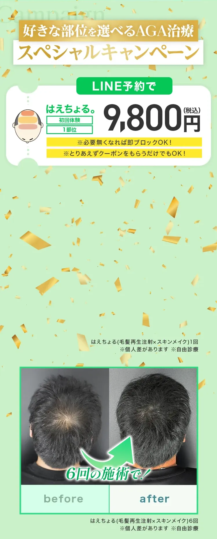 好きな部位を選べるAGA治療スペシャルキャンペーン