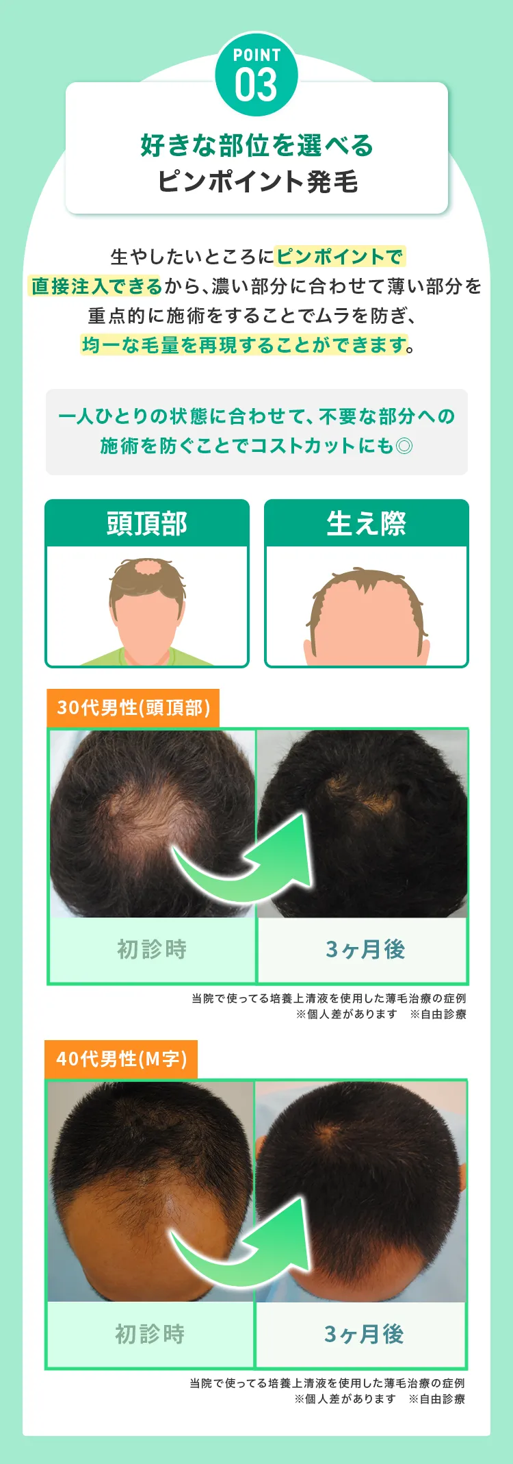 point03好きな部位を選べるピンポイント発毛