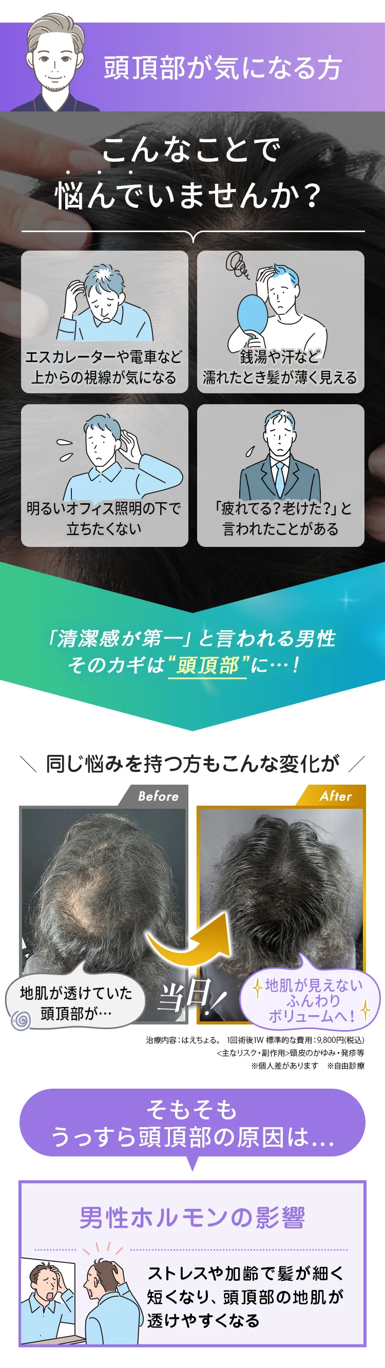 頭頂部の薄毛